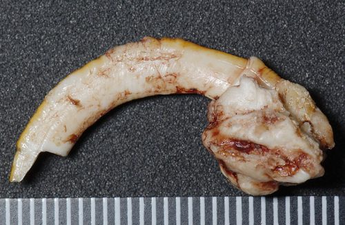 プレーリー歯牙腫